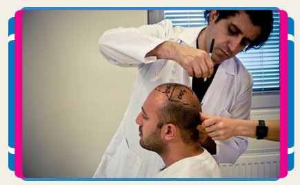 Best Hair Transplant in Turkey