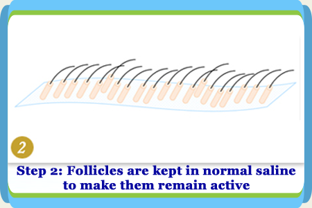 Follicular Unit Extraction Step 2 in China