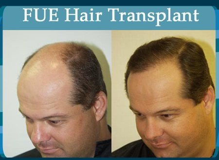 affordable hair transplant