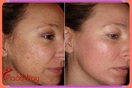 Skin Rehuvenation Therapies in Europe Skin Rejuvenation Therapies in Europe Swiss Medica