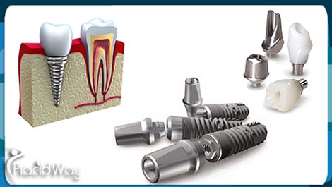 Dental Implants in Istanbul at Dentart Dental Implants in Istanbul at Dentart