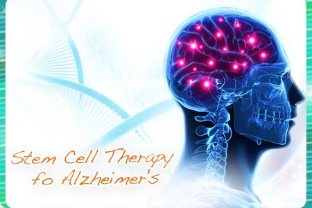 Alzheimers Disease Treatment with Stem Cell Therapy