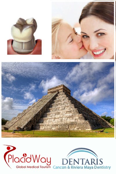 Dental Crowns in Cancun Mexico