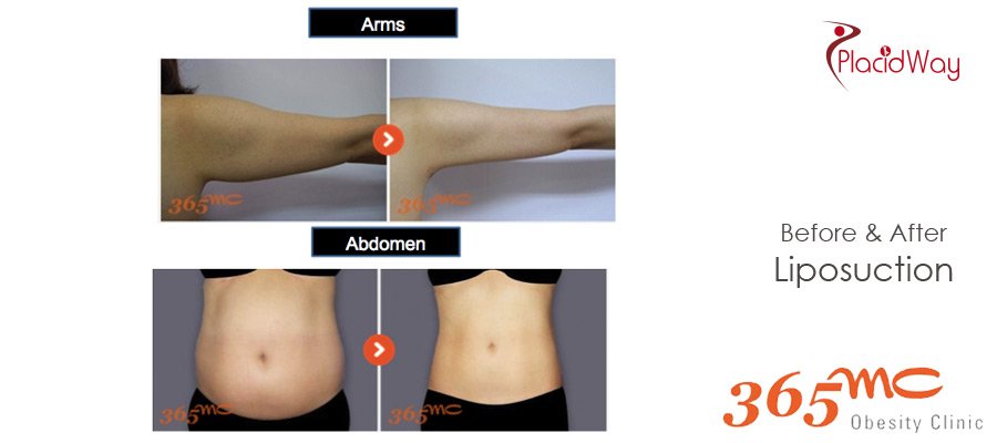 http://www.placidway.com/testimonial/533/Before_and_After_Whole_Abdomen_Arm_Liposuction_South_Korea