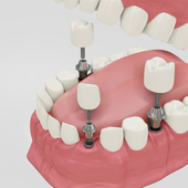 All on 4 in Turkey - High Quality Dental Implants 