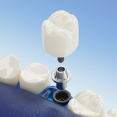  Choose Affordable Dental Implants in Cancun, Mexico