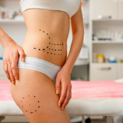 Mommy Makeover in Merida, Mexico by Dr. Ernesto Acosta Abeyta