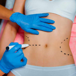 Liposuction Package in Merida, Mexico by Dr. Ernesto