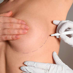 Breast Lift Surgery in Merida, Mexico by Dr. Ernesto