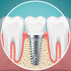 Low-Cost Dental Implants Los Algodones, Mexico