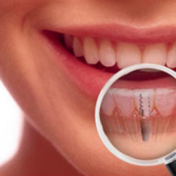 Dental Implant Package in San Jose, Costa Rica by American Dental Care