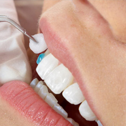 Dental Veneers at Americas Dental Care Costa Rica