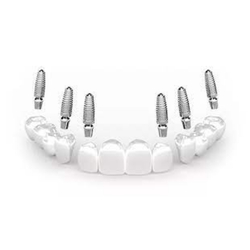 All on 6 Dental Implants Package in Los Algodones, Mexico