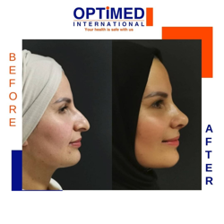 Nose Surgery Package in Istanbul Turkey at Optimed Hospital