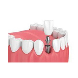 Affordable Dental Implant Package in Cancun, Mexico