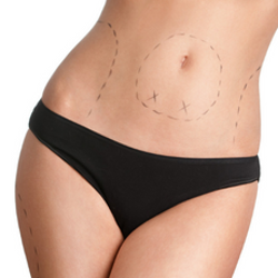 Effective Package for Gastric Sleeve Surgery in Merida, Mexico by Bypass Gastrico