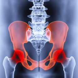 Check out Popular Packages for Hip Replacement in Mexico
