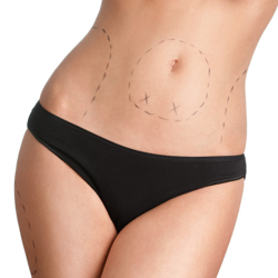 Best Tummy Tuck in the Dominican Republic -  $3200