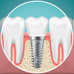 Go for Popular Treatment Packages for Dental Implants in Colombia