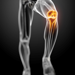 Meniscus Repair Surgery Packages in Mexico