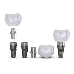 Best Package for Dental Implant in Tijuana, Mexico