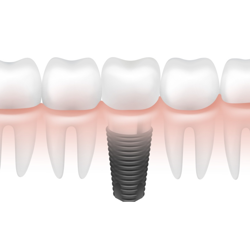 Cheap Package for Dental Implants in Cancun, Mexico