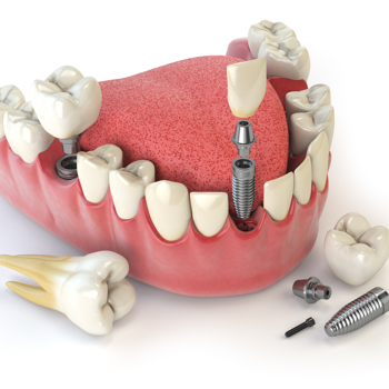 Choose All on 4 Dental Implants in Los Algodones, Mexico