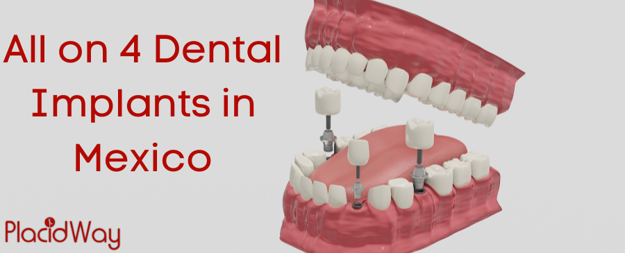 All on 4 Dental Implants in Mexico