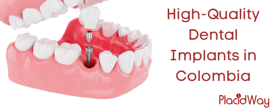 High-Quality Dental Implants in Colombia