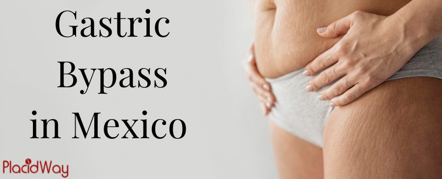 Gastric Bypass in Mexico - Lose Weight Today!