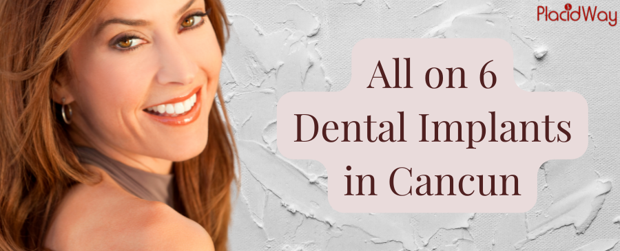 All on 6 Dental Implants in Cancun - Low-Cost Implants in Mexico