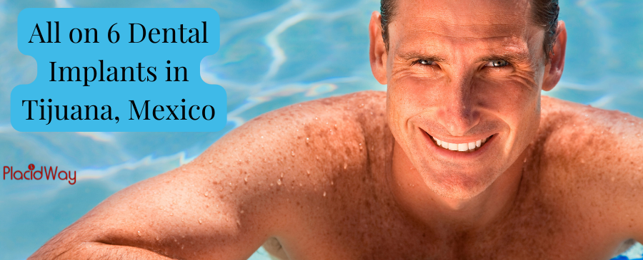 Get Your All on 6 Dental Implants in Tijuana, Mexico