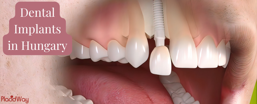 Dental Implants in Hungary for Your Confident Smile