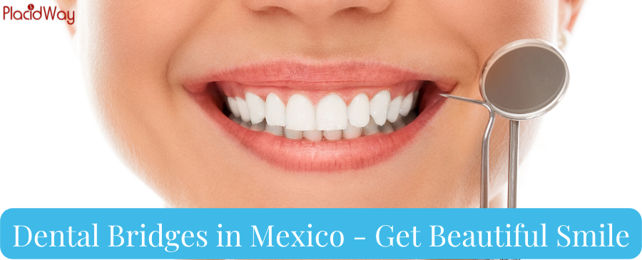 Dental Bridges in Mexico - Get Beautiful Smile