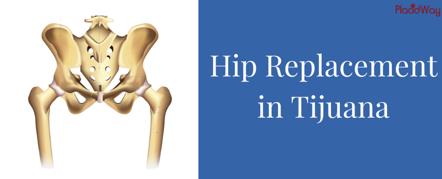Hip Replacement in Tijuana - Improve Your Hip Health