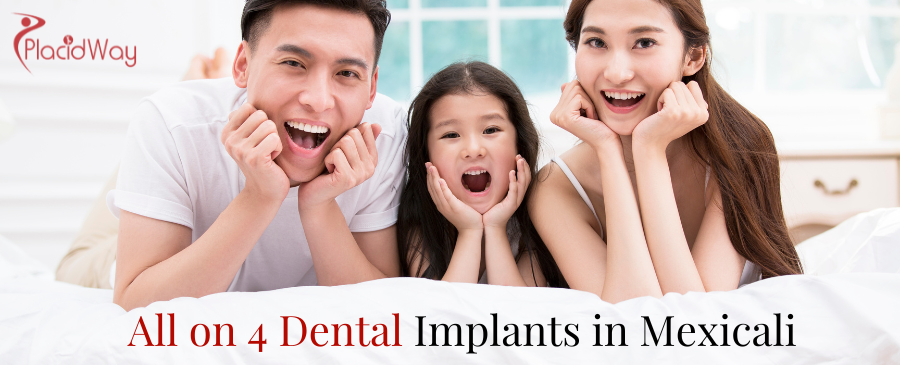 All on 4 Dental Implants in Mexicali