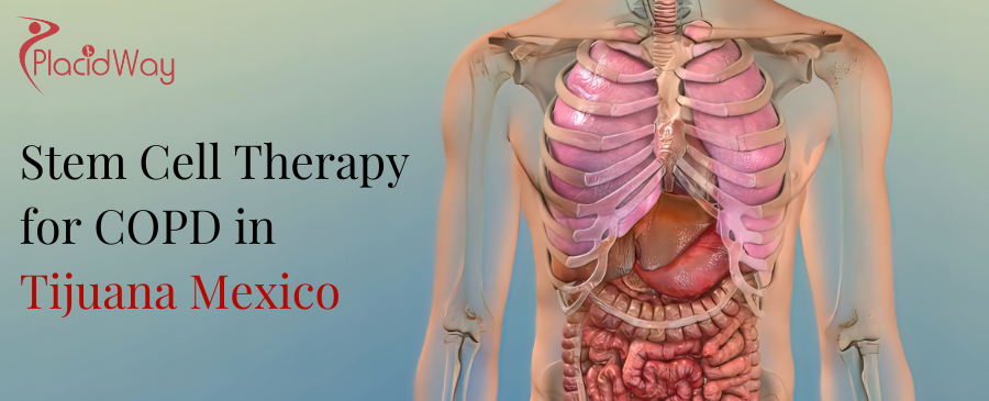Stem Cell Therapy for COPD in Tijuana Mexico