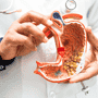 Stage 4 Colon Cancer Treatment in Mexico
