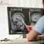 Solid Tumors and CAR T-Cells: Can This Therapy Work Beyond Blood Cancers?