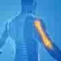 Shoulder and Elbow Surgeries in Mexico: Affordable and Quick Solutions for Canadians