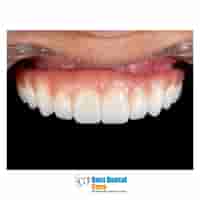 35% OFF Full-Arch Dental Treatments â€“ Limited-Time Promotion