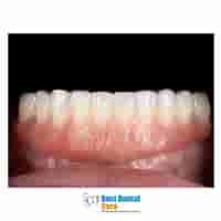 35% OFF Full-Arch Dental Treatments â€“ Limited-Time Promotion