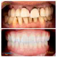 35% OFF Full-Arch Dental Treatments â€“ Limited-Time Promotion