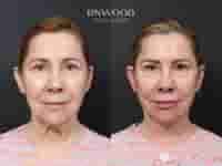 Deep Plane Face Lift, Deep Neck Lift, and Fat Graft Package in South Korea by RNWOOD Seoul