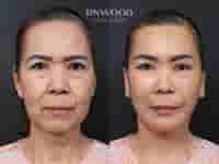 Deep Plane Face Lift, Deep Neck Lift, and Fat Graft Package in South Korea by RNWOOD Seoul