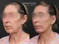 Deep Plane Face Lift, Deep Neck Lift, and Fat Graft Package in South Korea by RNWOOD Seoul