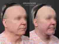 Deep Plane Face Lift, Deep Neck Lift, and Fat Graft Package in South Korea by RNWOOD Seoul