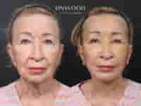 Revision Deep Plane Facelift Package in Seoul, South Korea by Dr. Minhee Ryu at RNWOOD