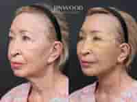 Revision Deep Plane Facelift Package in Seoul, South Korea by Dr. Minhee Ryu at RNWOOD