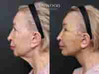 Revision Deep Plane Facelift Package in Seoul, South Korea by Dr. Minhee Ryu at RNWOOD